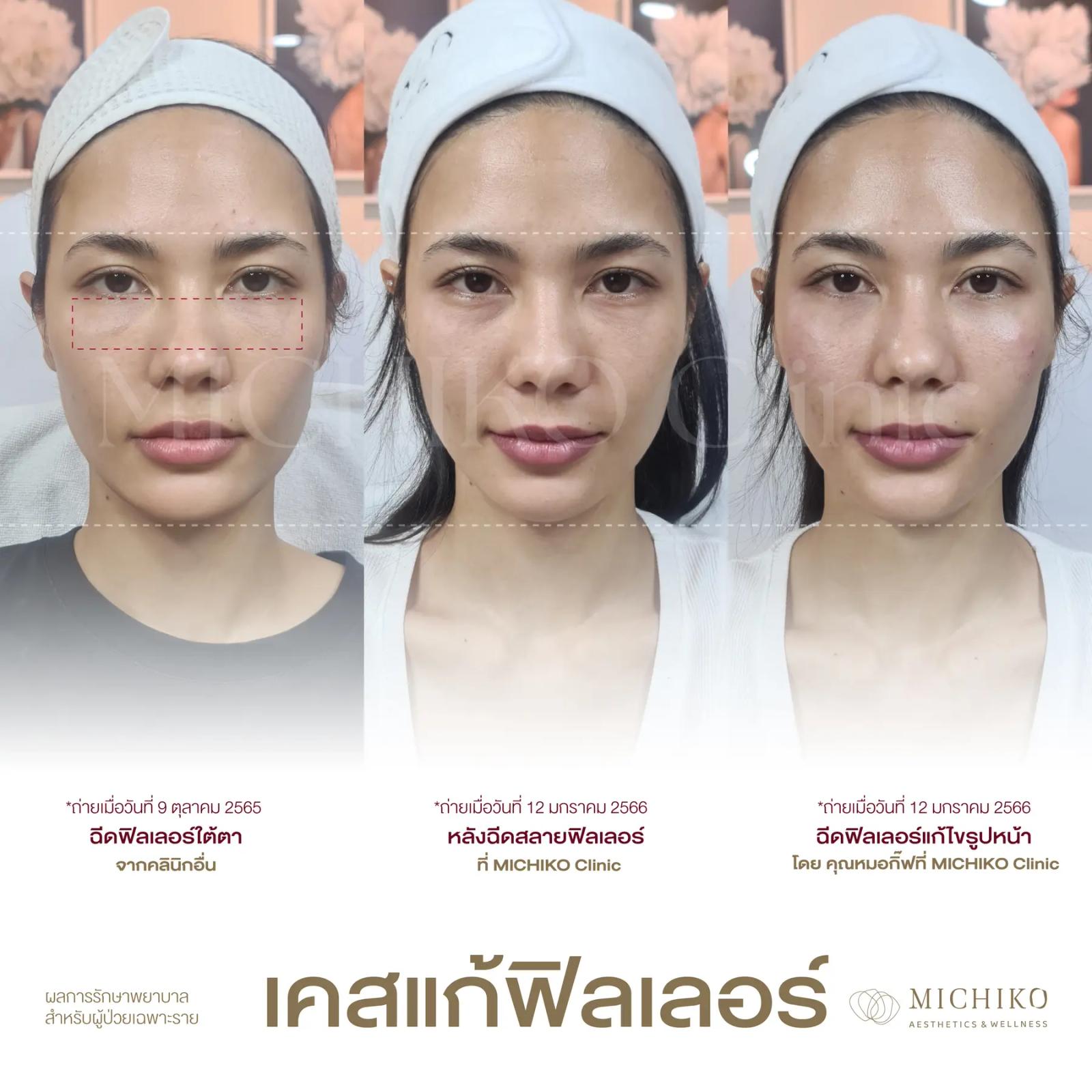 MICHIKO filler correction treatment progression